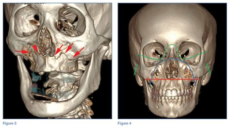 Emergency Imaging: Facial Trauma After a Fall | MDedge Emergency Medicine