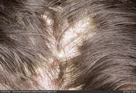 Crusty Bumps On Scalp