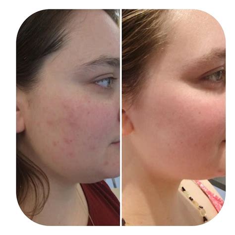 A before and after photo of our guest after using the Face Reality skin ...