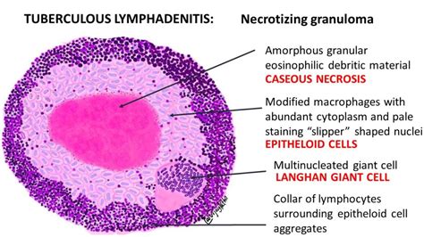 TUBERCULOUS LYMPHADENITIS - Pathology Made Simple