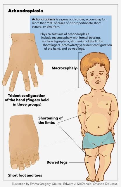 [Figure, Achondroplasia, trident configuration, macrocephaly, bowed ...