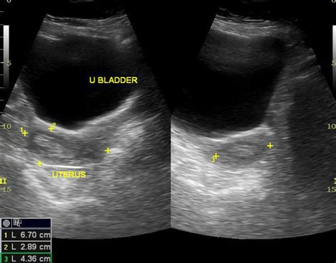 Endometrial hyperplasia ultrasound - wikidoc