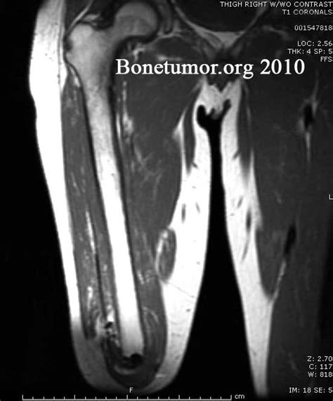 Epithelioid Sarcoma | BoneTumor.org