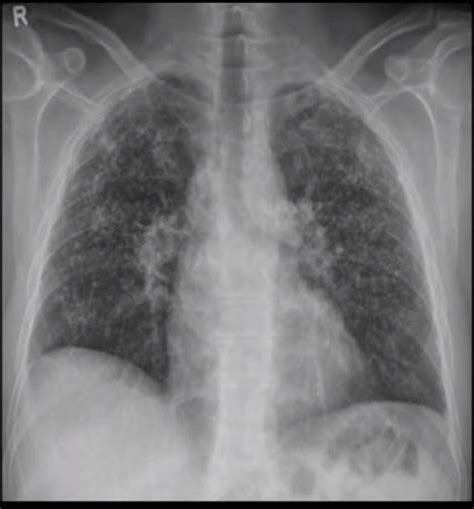 Interstitial Pneumonia X Ray