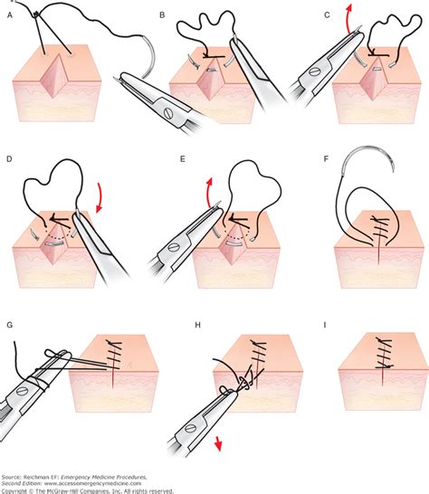 Laceration Repair - Guide to YKHC Medical Practices