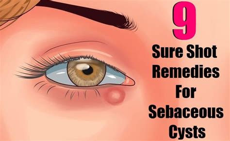 9 Sure Shot Remedies For Sebaceous Cysts | Eye cyst remedies, Cysts, Remedies