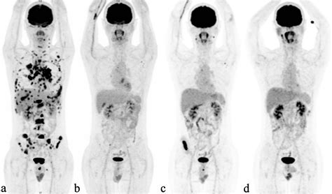 Pet Scan Images Of Lymphoma