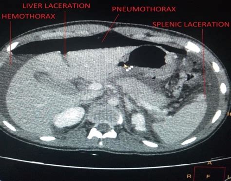 CT scan showing contrast in lesser sac. | Download Scientific Diagram