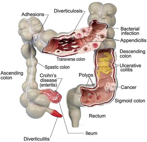 Colon cleansing, colon hydrotherapy, colonics, MA, RI, colonic ...