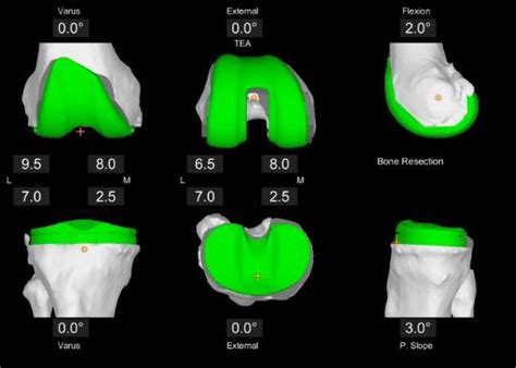 Mako Total Knee Replacement | SURGICAL HOSPITAL OF OKLAHOMA, LLC.