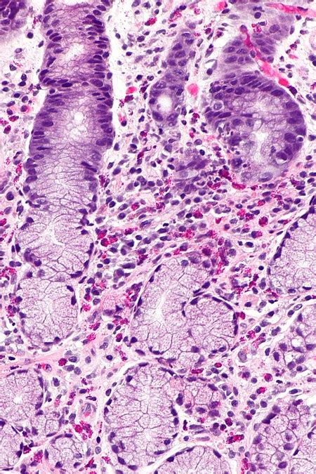 Eosinophilic gastritis - Libre Pathology