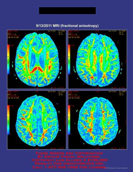 MRI Fractional Anisotropy