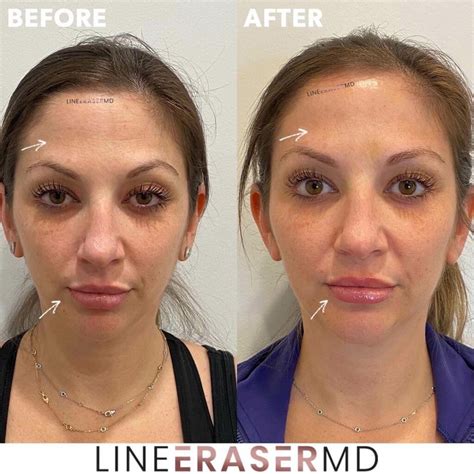 Botox Treatment In NJ: Before & After Gallery | Line Eraser MD