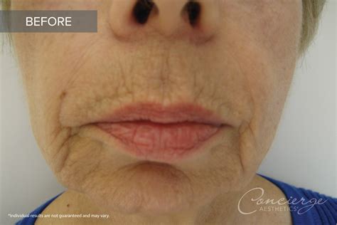 Before and After Photos - Juvederm In The Lips | Concierge Aesthetics