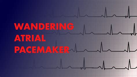 Wandering Atrial Pacemaker Rhythm Strip