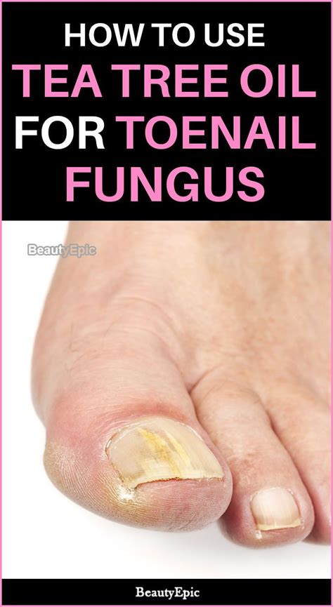How To Treat Mold Fungal Infection Toenail