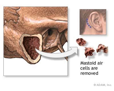 The New York Times > Health > Slide Show > Mastoidectomy > Slide 3 of 4