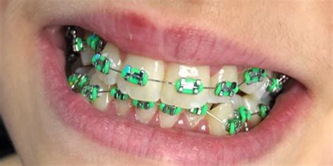 How green braces are perfect choice for your teeth? | Braces Explained