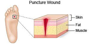 Puncture Wound - What You Need to Know