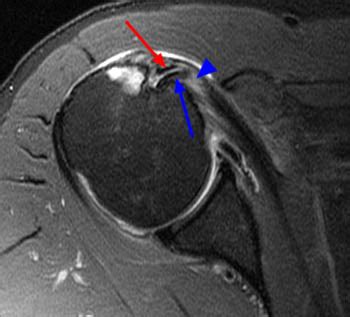 Biceps Rupture cause and sign ~ akufisio.blogspot