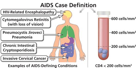 AIDS Case Definition | NIH