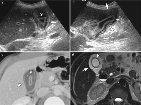 Cholesterolosis Of Gallbladder Radiology - A Pictures Of Hole 2018