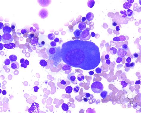 Multiple Myeloma - Large Plasma Cells - 4.