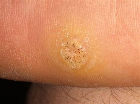 What Causes Plantar Warts: All Negative Factors Predisposing to Warts ...