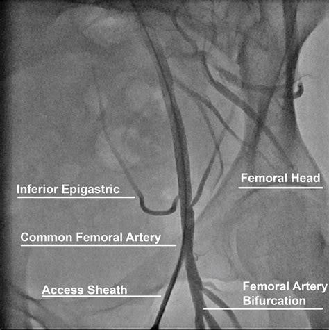 Contemporary Techniques for Femoral and Radial Arterial Access in the Cardiac Catheterization ...