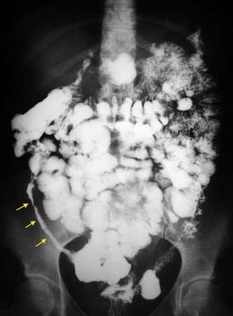 Crohn Disease - Barium Follow Through (2) - Radiology at St. Vincent's ...