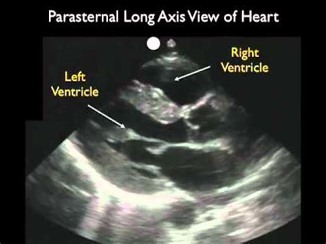 Cardiac Ultrasound - Parasternal Long Axis - Part 1 - Sonosite, Inc. - YouTube