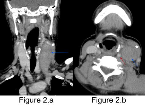 Cureus | Internal Jugular Vein Thrombosis: Unusual Diagnosis of a Cervical Mass