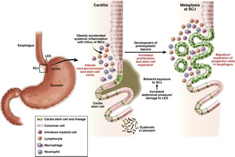 The Rapid Rise in Gastroesophageal Junction Tumors: Is Inflammation of ...