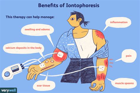 Iontophoresis in Physical Therapy (2022)