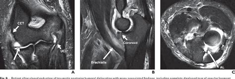 Figure 9 from MRI of the annular ligament of the elbow: review of ...