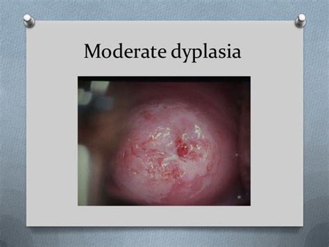 Cervical dysplasia