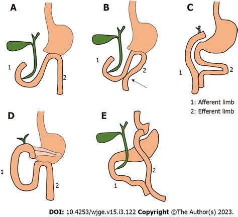 Billroth 2 Anatomy