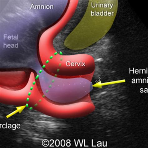 📃 Cervical incompetence, herniated amniotic sac through the cervical ...