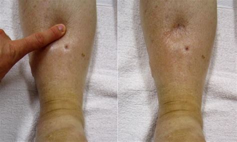 Pitting edema: Causes, treatment, and more | Pitting edema, Edema causes, Edema