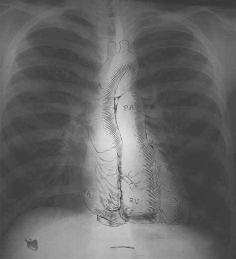 Normal Chest X-Ray • LITFL Medical Blog • Labelled Radiology