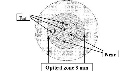 Diagram of bifocal contact lenses. The lenses are spherical and ...