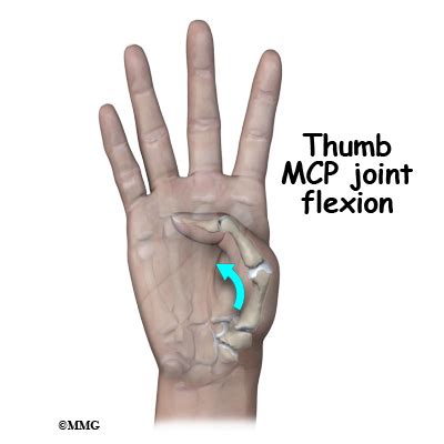 Adult Thumb Metacarpal Fractures - James Seeds, MD, Orthopedic & Sports ...