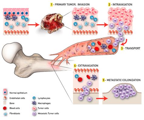 Tumor progression and bone metastasis process. | Download Scientific Diagram