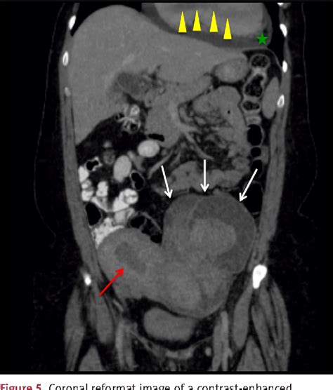 Figure 5 from Multimodality Evaluation of Intravenous Leiomyomatosis: A ...