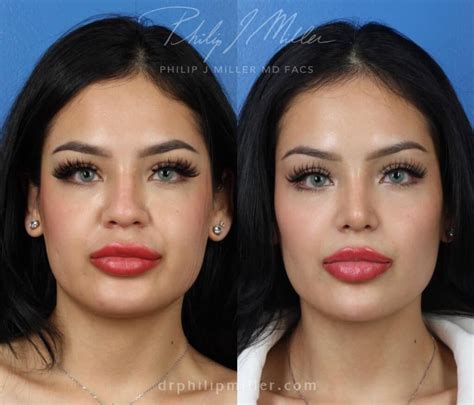 How to Make My Face More Symmetrical - Philip Miller, MD, FACS