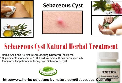 Sebaceous Cyst Infection Sebaceous Cyst Home Treatment Sebaceous Cyst | Images and Photos finder