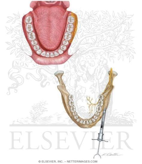 Long Buccal Nerve Block