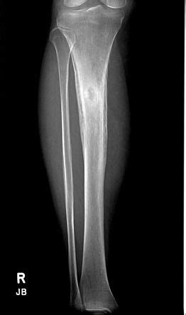 Brodie abscess | Radiology Case | Radiopaedia.org | Радиология, Здоровье