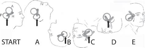 Figure 1 from A Comparison of Two Home Exercises for Benign Positional ...