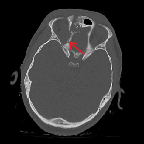 Right medial orbital wall fracture showing route of CSF leak. | Download Scientific Diagram